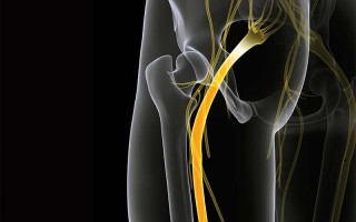 Sciatica